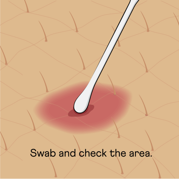 Image of cotton swap cleaning tick bite with text "swab and check the area"