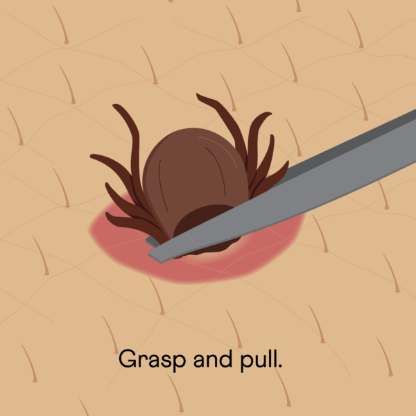 Image of tweezers pulling out a tick from person's skin with the text "grasp and pull"