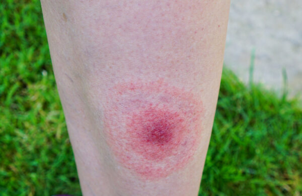 Image of bullseye rash at site of tick bite on a person's leg which may be a symptom of Lyme disease