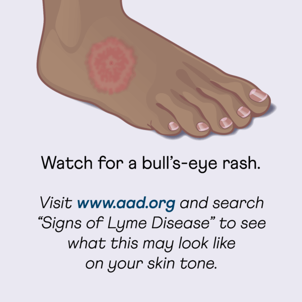 Bullseye rash on person's foot at site of tick bite with text "watch for a bull's-eye rash. Visit www.aad.org and search 'signs of Lyme disease' to see what this may look like on your skin tone."