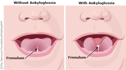 Illustrated diagram from KidsHealth.org showing a side-by-side comparison of a baby's mouth without ankyloglossia (tongue tie) and with ankyloglossia