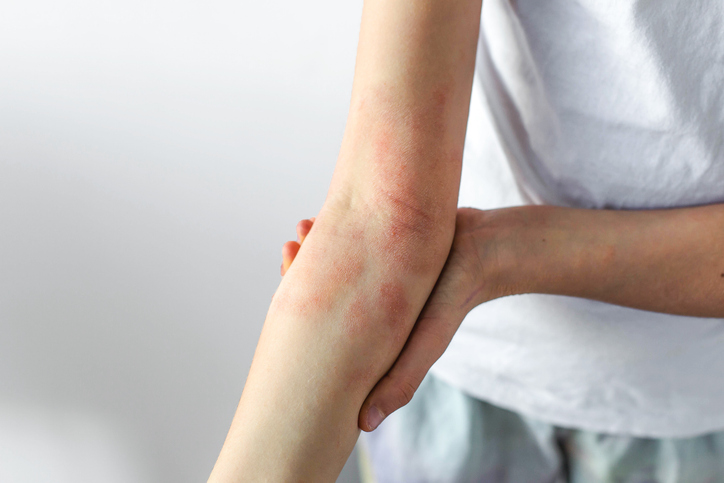 Child forearm with visible eczema irritation red patches, sensitive dry skin affected by atopic dermatitis which often appears in elbow creases, the backs of the knees, on the neck, and around the eyes