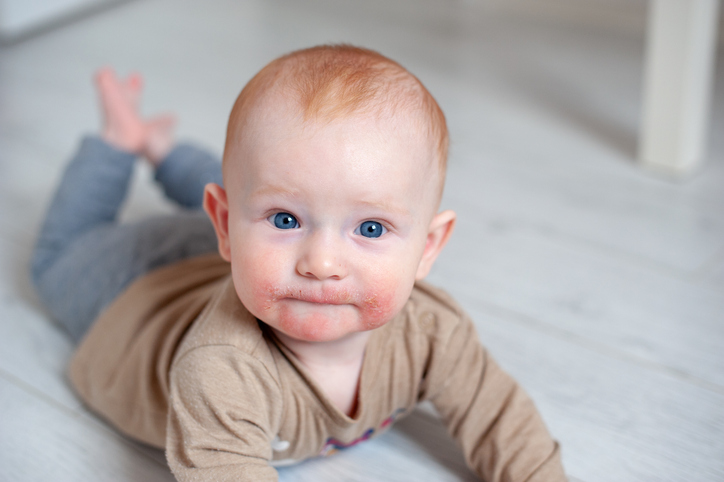 Baby with rashes on his face that are typical of eczema or atopic dermatitis