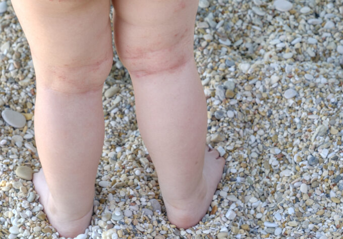 Eczema rash on the back of baby's knees