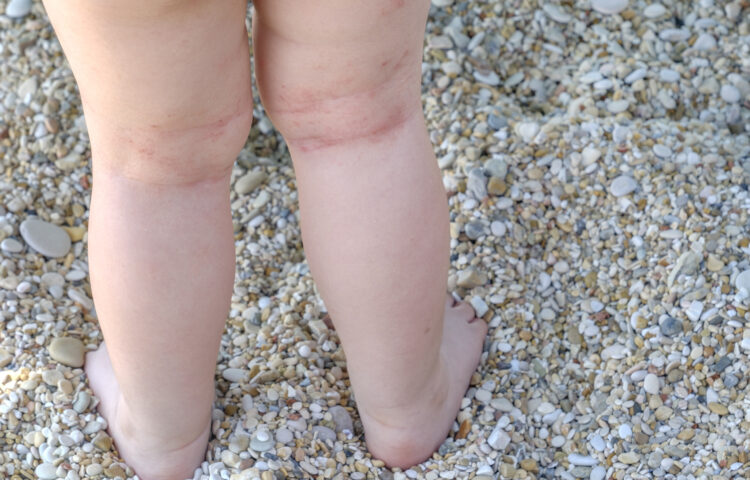 Eczema rash on the back of baby's knees