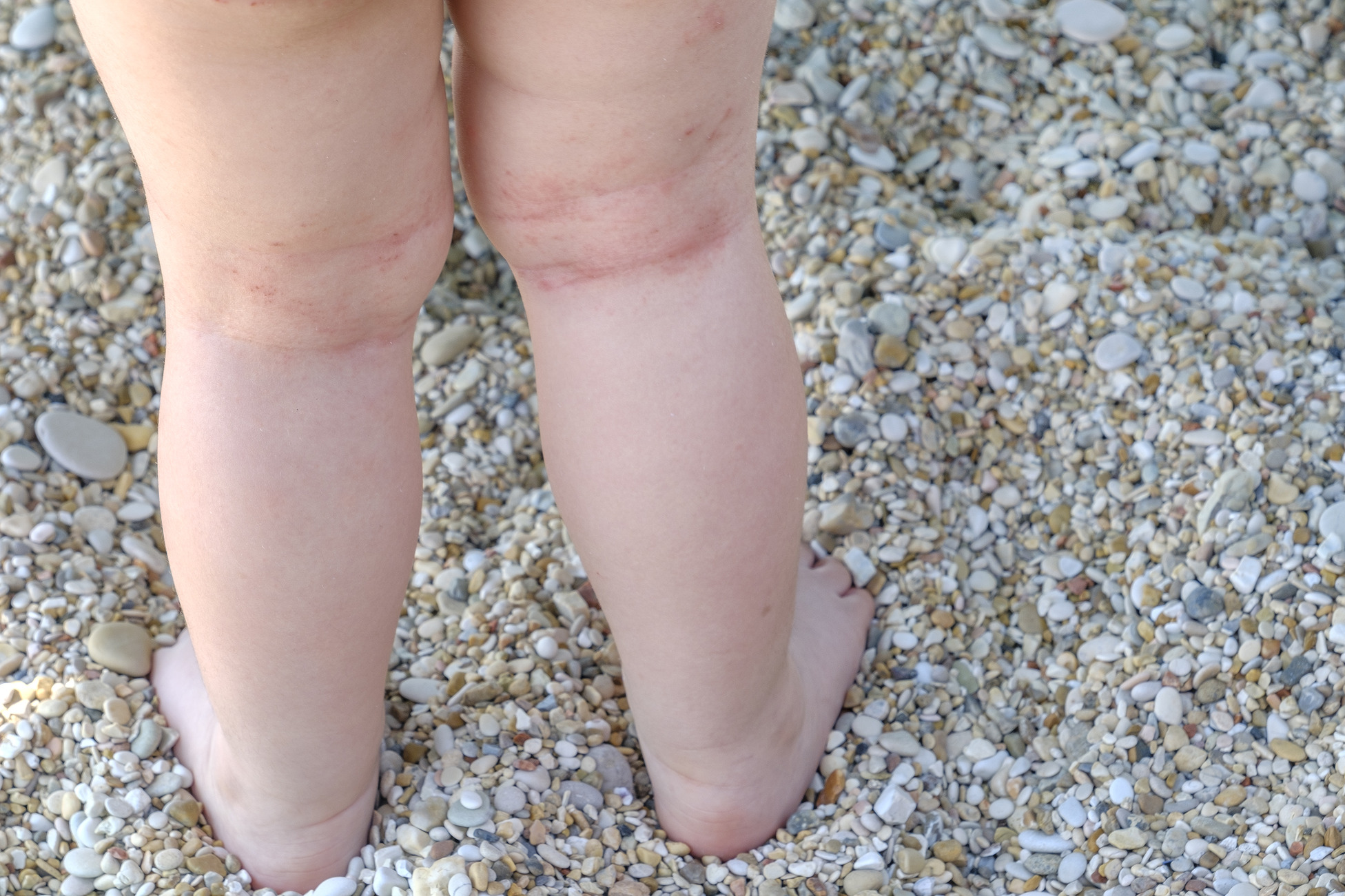 Eczema rash on the back of baby's knees