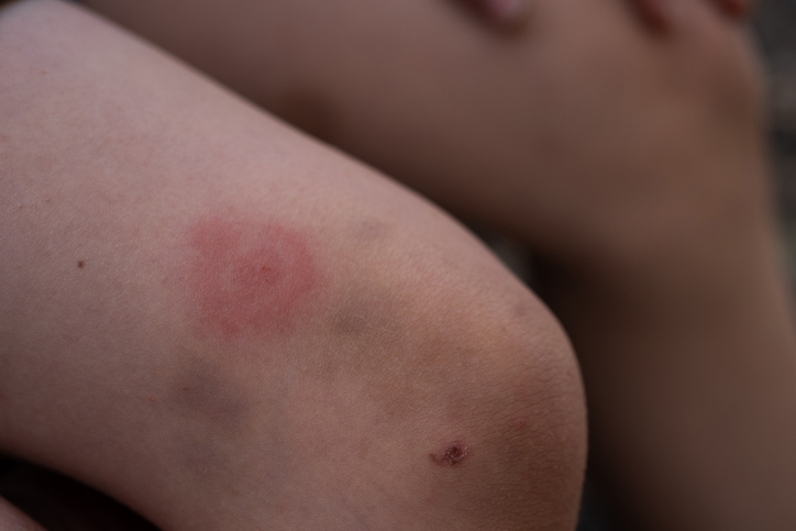 Closeup image of a bullseye rash on a child's knee which can be a symptom of Lyme disease.